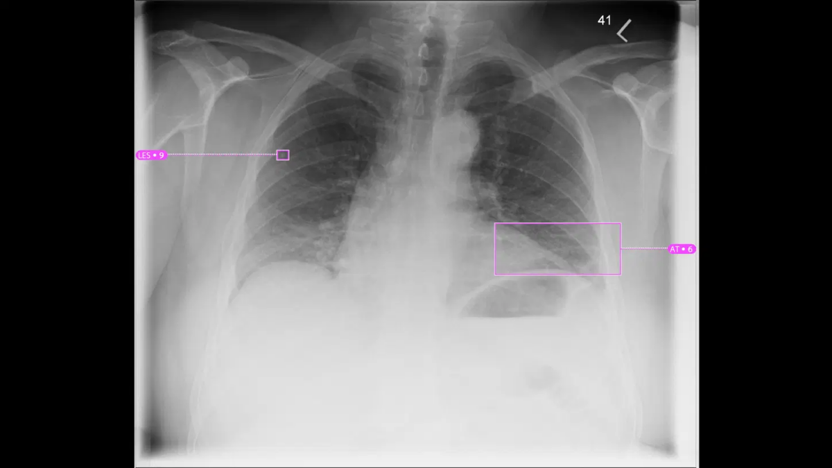 PA chest x-ray of a patient showing an AI-Rad Companion Chest X-ray lung lesion